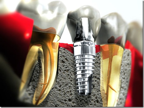 Implante dentário de titânio